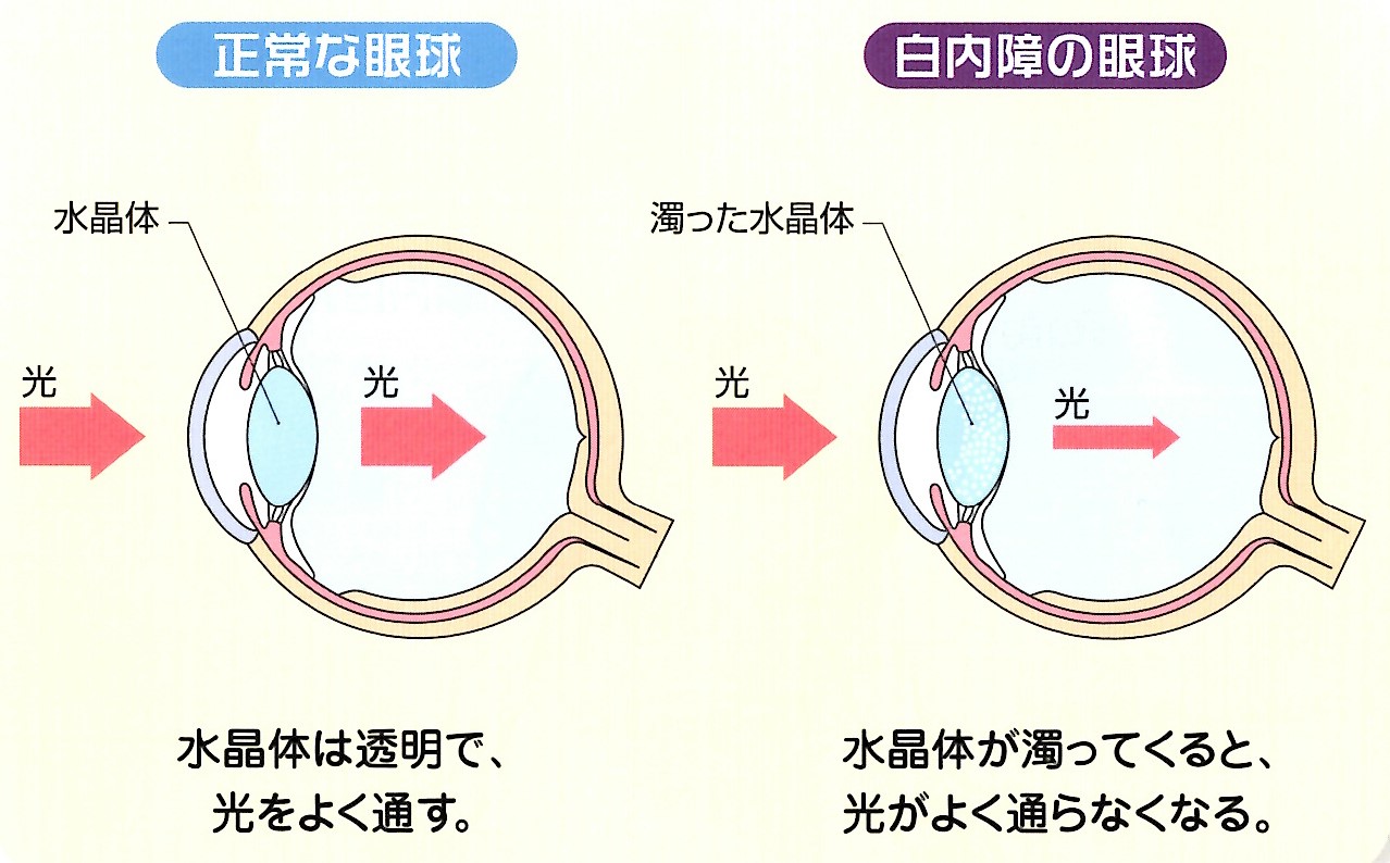 白内障とは