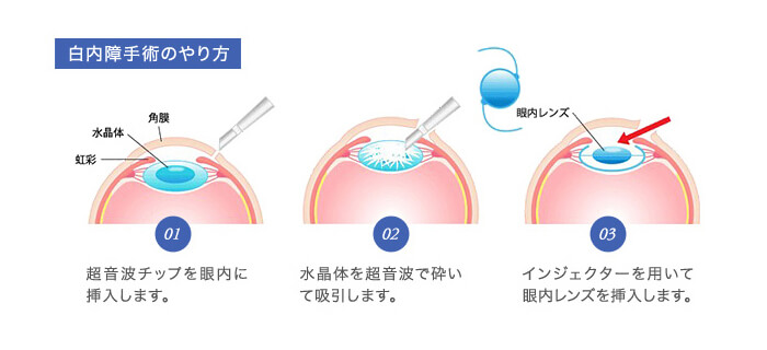 白内障の手術方法について